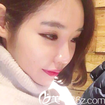 自体脂肪填充全脸术后15天自拍 自体脂肪填充全脸术后15天自拍