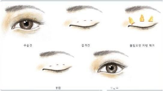 韩式三点定位双眼皮