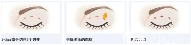 韩式三点定位双眼皮能维持多久