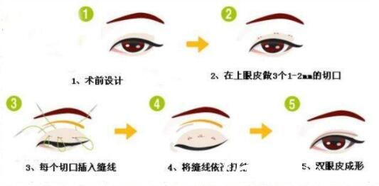 上海美莱韩式三点定位双眼皮手术方法