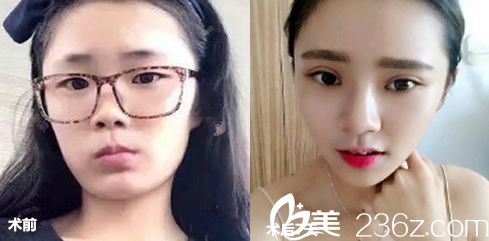 找合肥壹加壹孟松做全切双眼皮案例