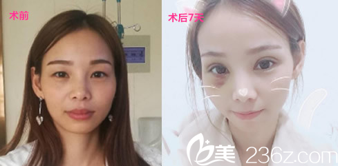 合肥华美徐海燕眼综合整形案例效果前后对比图