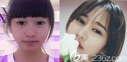 合肥韩美刘冷怎么样？看韩美刘冷全切双眼整形案例一览