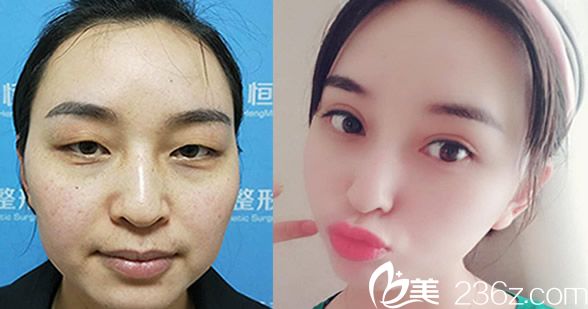 合肥恒美廖亚敏双眼皮案例公布
