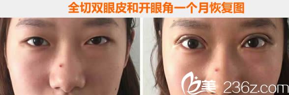兰州梦想整形全切双眼皮和开眼角1个月恢复<span style= 兰州梦想整形全切双眼皮和开眼角1个月恢复<span style=