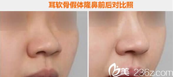 兰州梦想耳软骨假体隆鼻前后对比<span style= 兰州梦想耳软骨假体隆鼻前后对比<span style=