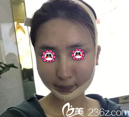 在北京华韩做面部吸脂第4天