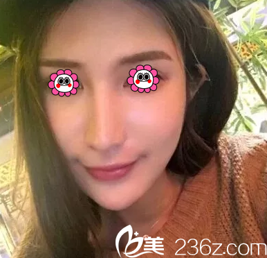 北京华韩余恩旭给我做面部吸脂8天