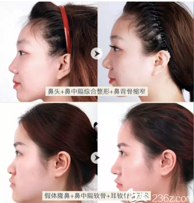 鲁礼新鼻部整形真人案例