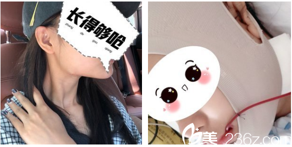 在深圳非凡找罗奇做下颌角手术前 在深圳非凡找罗奇做下颌角手术前