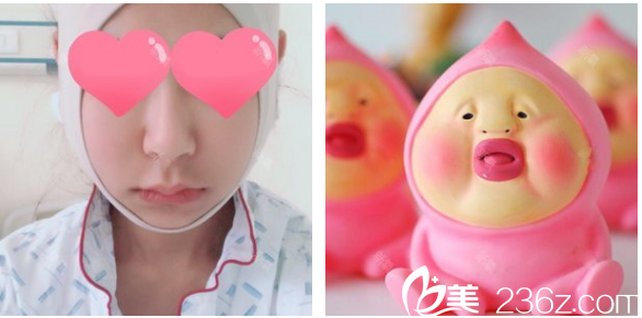 整形医生罗奇博士做的下颌角术后第二天 整形医生罗奇博士做的下颌角术后第二天