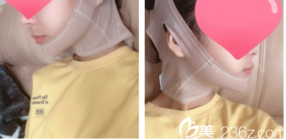 下颌角磨骨七天拆线效果图 下颌角磨骨七天拆线效果图