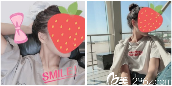 深圳非凡罗奇博士做的下颌角磨骨真人案例 深圳非凡罗奇博士做的下颌角磨骨真人案例