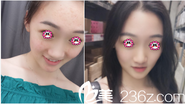 北京华韩邢志花微针案例 北京华韩邢志花微针案例