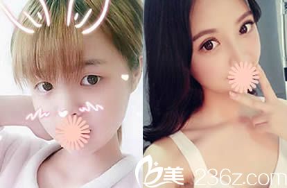 福州名韩林峰个人案例双眼皮前后对比图 福州名韩林峰个人案例双眼皮前后对比图