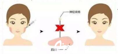 脸部多久能消肿？