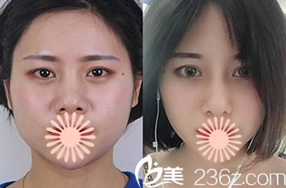 福州名韩林峰个人案例假体隆鼻前后对比图