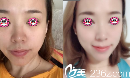 北京华韩赵子涓热玛吉美肤案例 北京华韩赵子涓热玛吉美肤案例