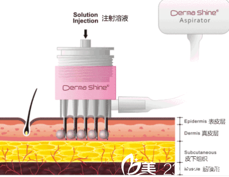 水光嫩肤示意图 水光嫩肤示意图
