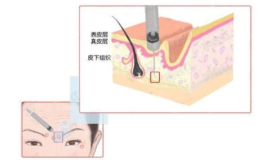 除皱原理图解