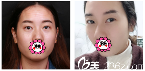 除皱案例对比图