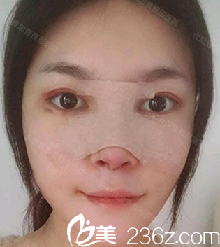 找合肥壹加壹甘泉涌做肋软骨鼻综合术后第1天照片