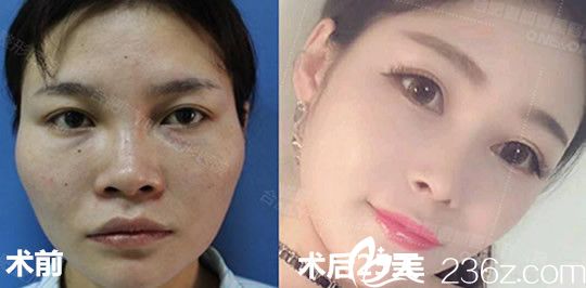 肋软骨隆鼻+玻尿酸填充太阳穴前后效果对比图
