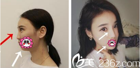 张<!--<i data=20240703-sp></i>-->玻尿酸隆鼻垫下巴 张<!--<i data=20240703-sp></i>-->玻尿酸隆鼻垫下巴