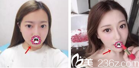 <!--<i data=20240703-sp></i>-->汪国应玻尿酸垫下巴案例 <!--<i data=20240703-sp></i>-->汪国应玻尿酸垫下巴案例