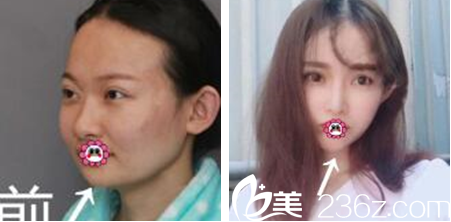 贵州利美康田士云打玻尿酸效果怎么样 贵州利美康田士云打玻尿酸效果怎么样