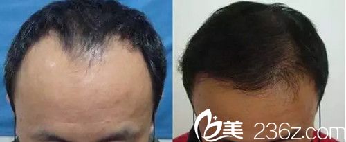 毛发种植术前术后对比效果