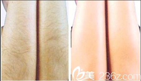 激光脱毛手术前后对比效果 激光脱毛手术前后对比效果