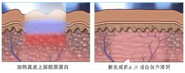 点阵激光治疗妊娠纹原理