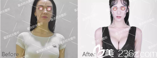 重庆时光冯辉利假体隆胸案例 重庆时光冯辉利假体隆胸案例