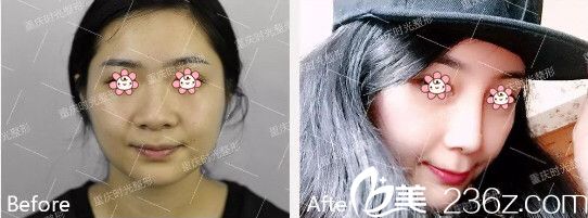 重庆时光陈玉连假体隆鼻案例 重庆时光陈玉连假体隆鼻案例