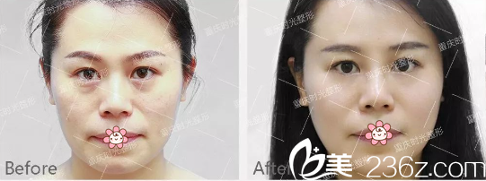 重庆时光范眉清自体脂肪全脸填充案例 重庆时光范眉清自体脂肪全脸填充案例