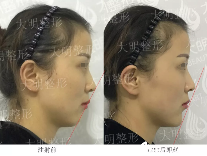 20分钟注射玻尿酸就改善了20多年的塌下巴 连云港大明员工亲证张培鉴院长微整效果