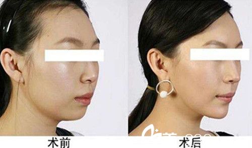 注射完瘦脸案例