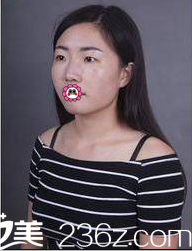 在北京京韩做双眼皮隆鼻前样子 在北京京韩做双眼皮隆鼻前样子