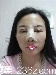 北京京韩做全切双眼皮假体隆鼻第3天样子 北京京韩做全切双眼皮假体隆鼻第3天样子