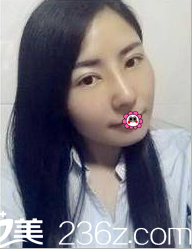 北京京韩张振给我做双眼皮隆鼻第35天效果 北京京韩张振给我做双眼皮隆鼻第35天效果