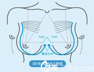 重庆时光In-Bra完美丰胸术 重庆时光In-Bra完美丰胸术