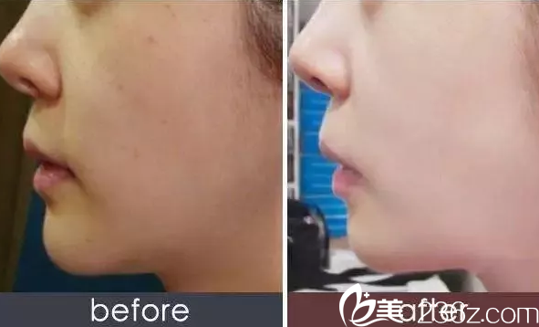 南宁韩星注射案例