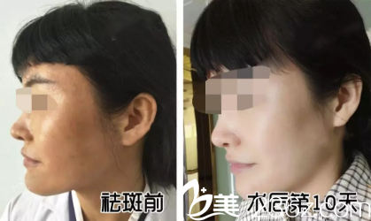 贵州利美康祛斑怎么样 贵州利美康祛斑怎么样