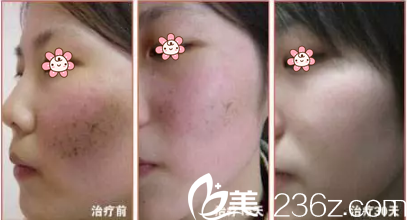 张<!--<i data=20240703-sp></i>-->激光祛斑效果 张<!--<i data=20240703-sp></i>-->激光祛斑效果