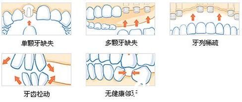 上海薇琳医疗美容医院马晓蓬需要种植的牙齿类型