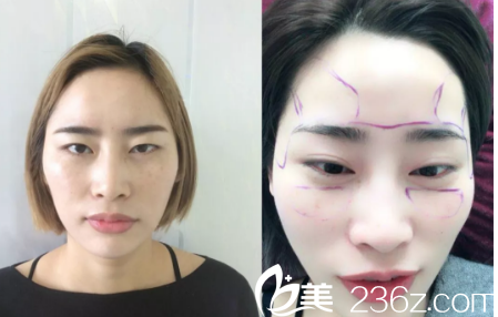 在济南做了2个项目,隆鼻+自体脂肪填充 在济南做了2个项目,隆鼻+自体脂肪填充