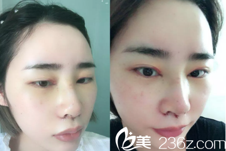 看我鼻子上起的痂 看我鼻子上起的痂