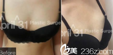 韩国4月31日整形外科隆胸术前照 韩国4月31日整形外科隆胸术前照