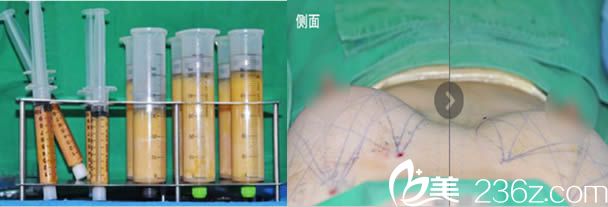 韩国4月31日整形外科自体脂肪隆胸术后即刻照 韩国4月31日整形外科自体脂肪隆胸术后即刻照